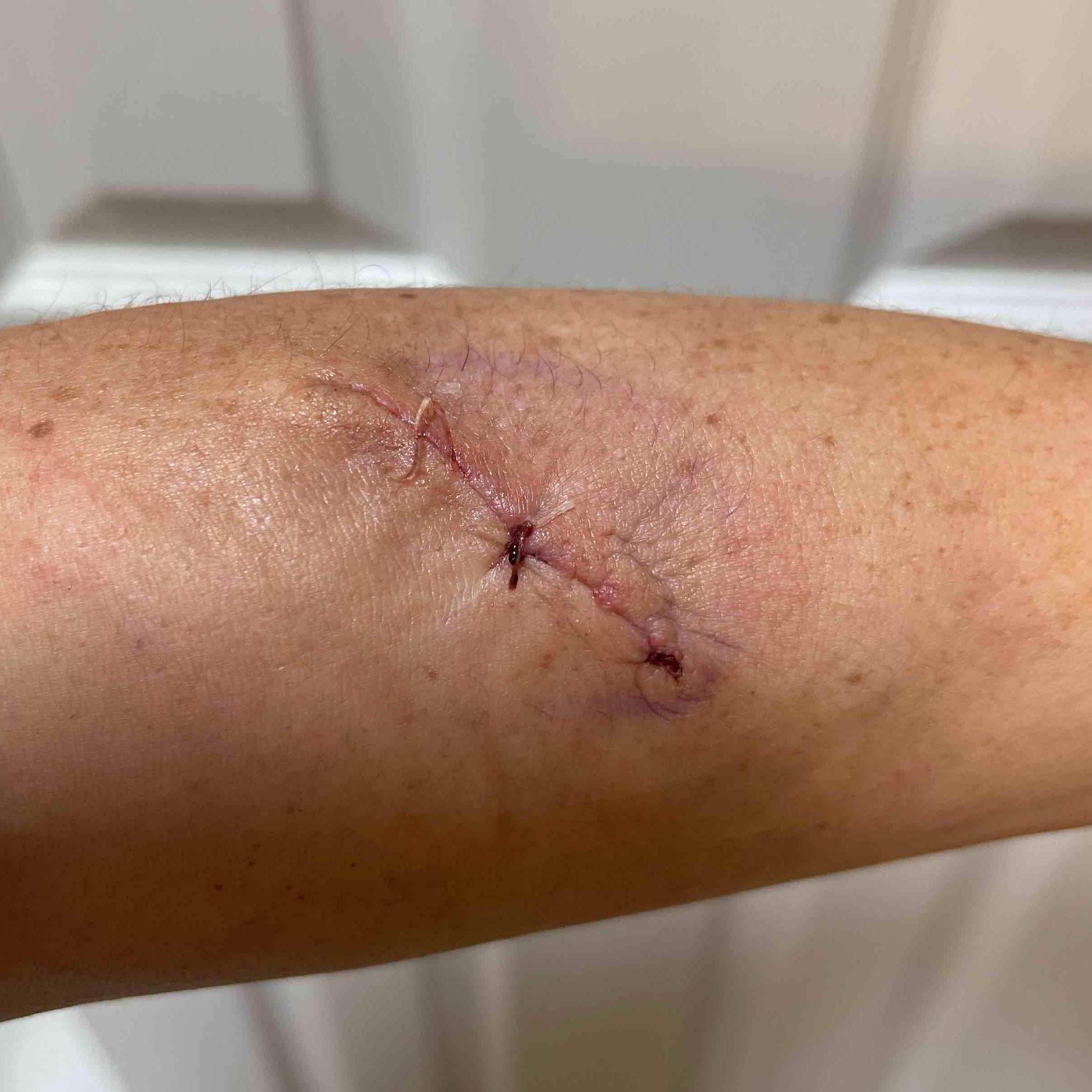 Lipoma Before and After Case 6 After