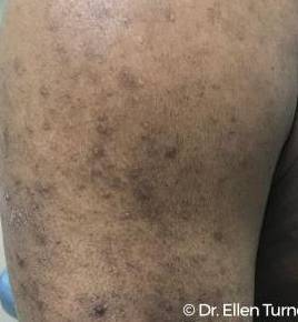 Eczema Before and After Case 6 Before