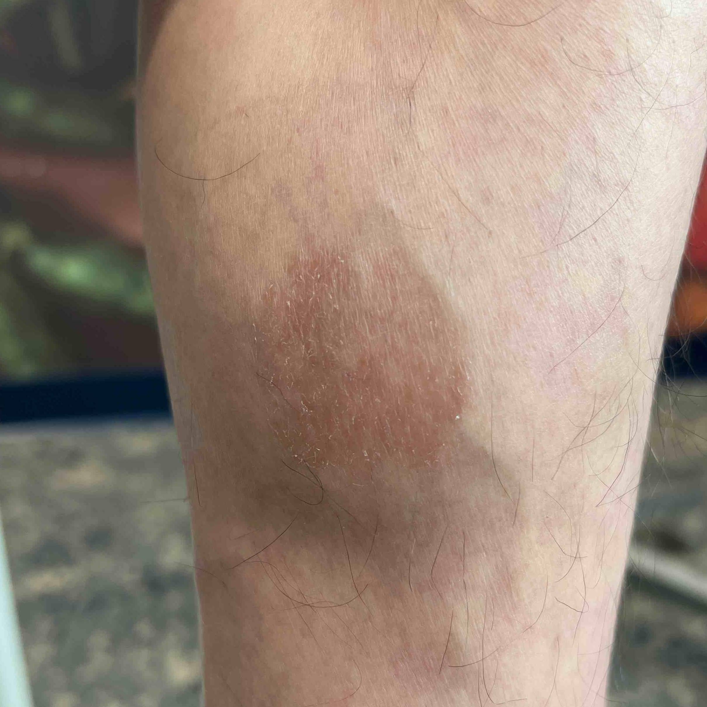 Allergic Contact Dermatitis Case-19 Before