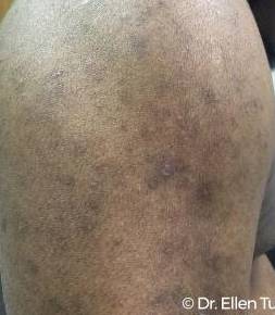Eczema Before and After Case 6 After