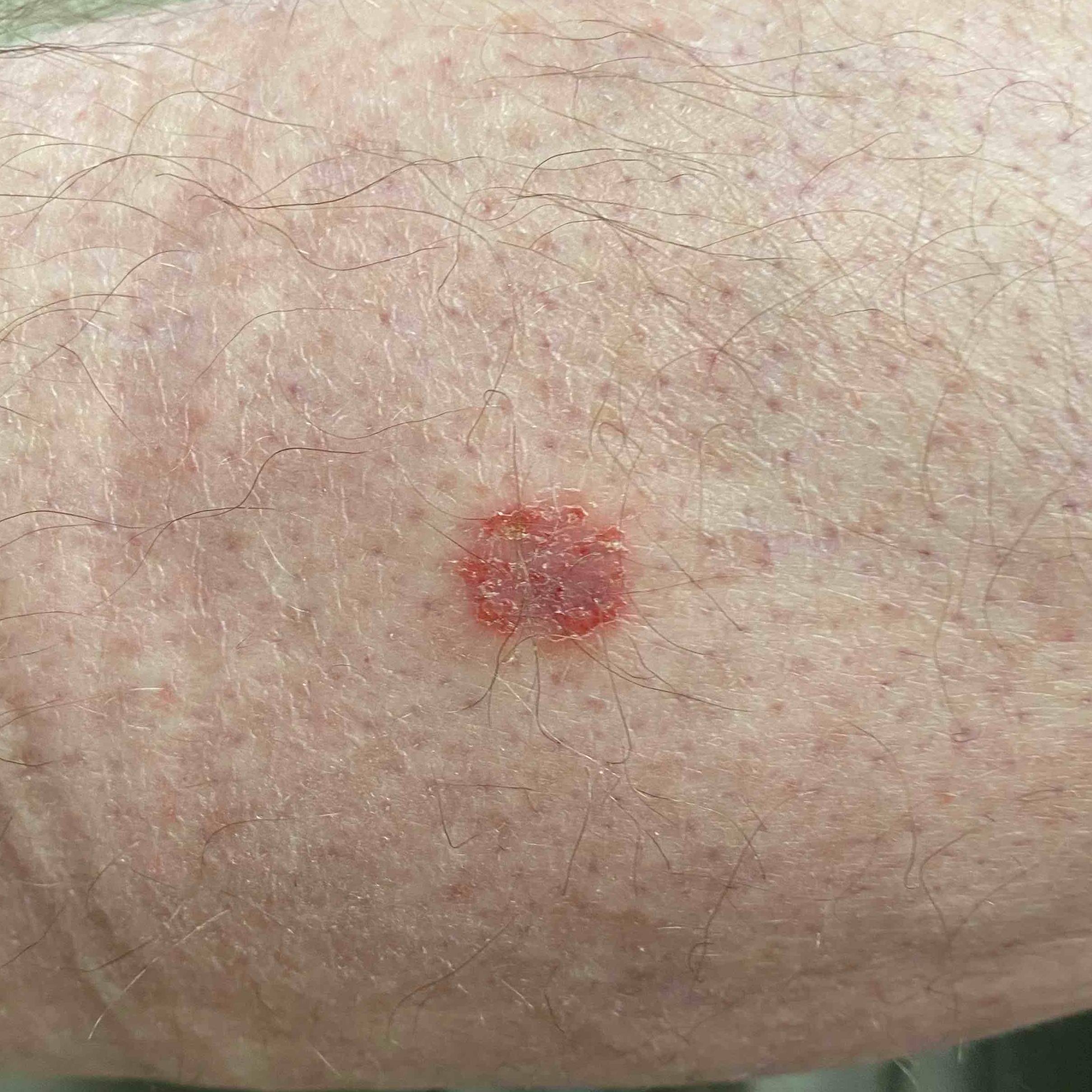 Atopic Dermatitis Before and After Case-36 Before