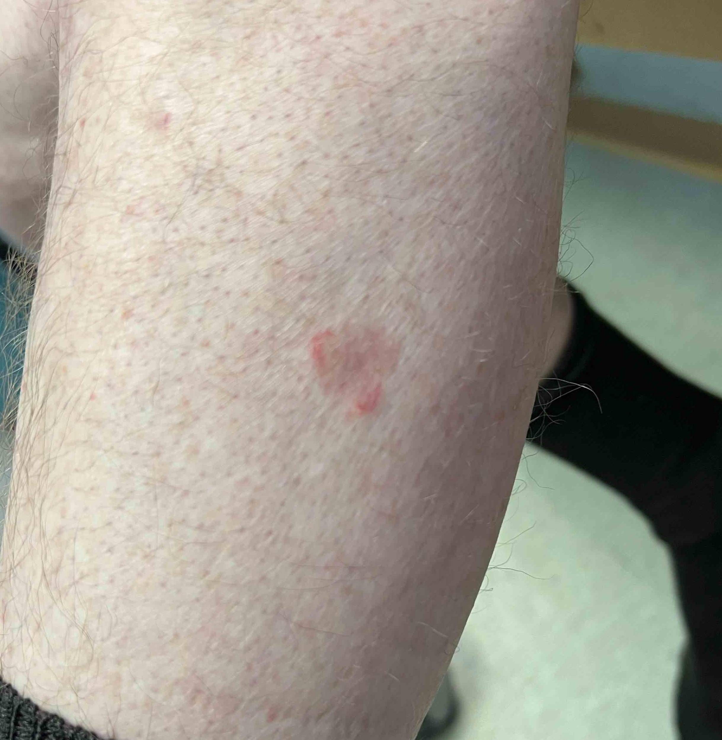 Atopic Dermatitis Before and After Case-36 After