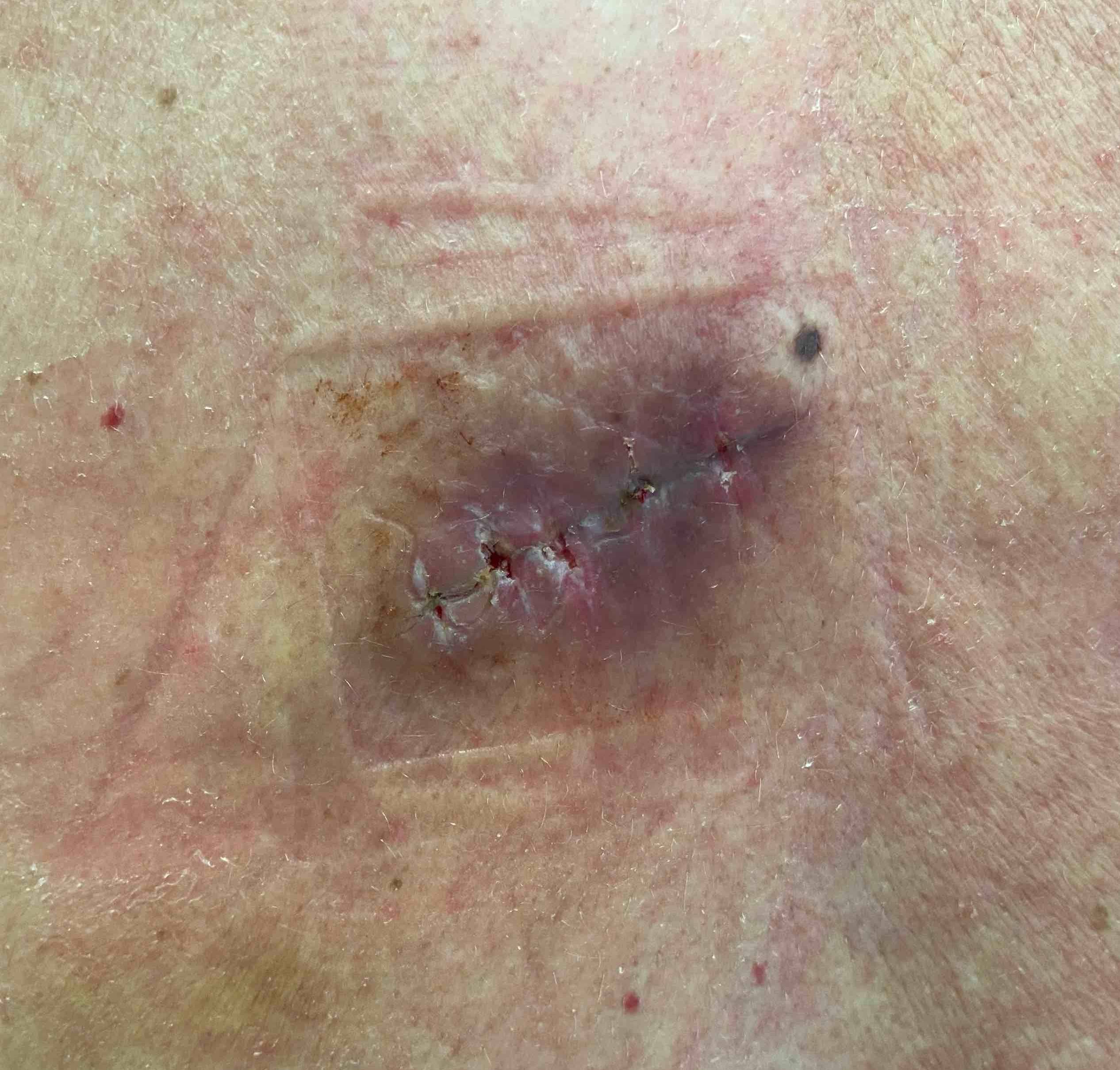 Cyst Removal Before and After Case-18 After