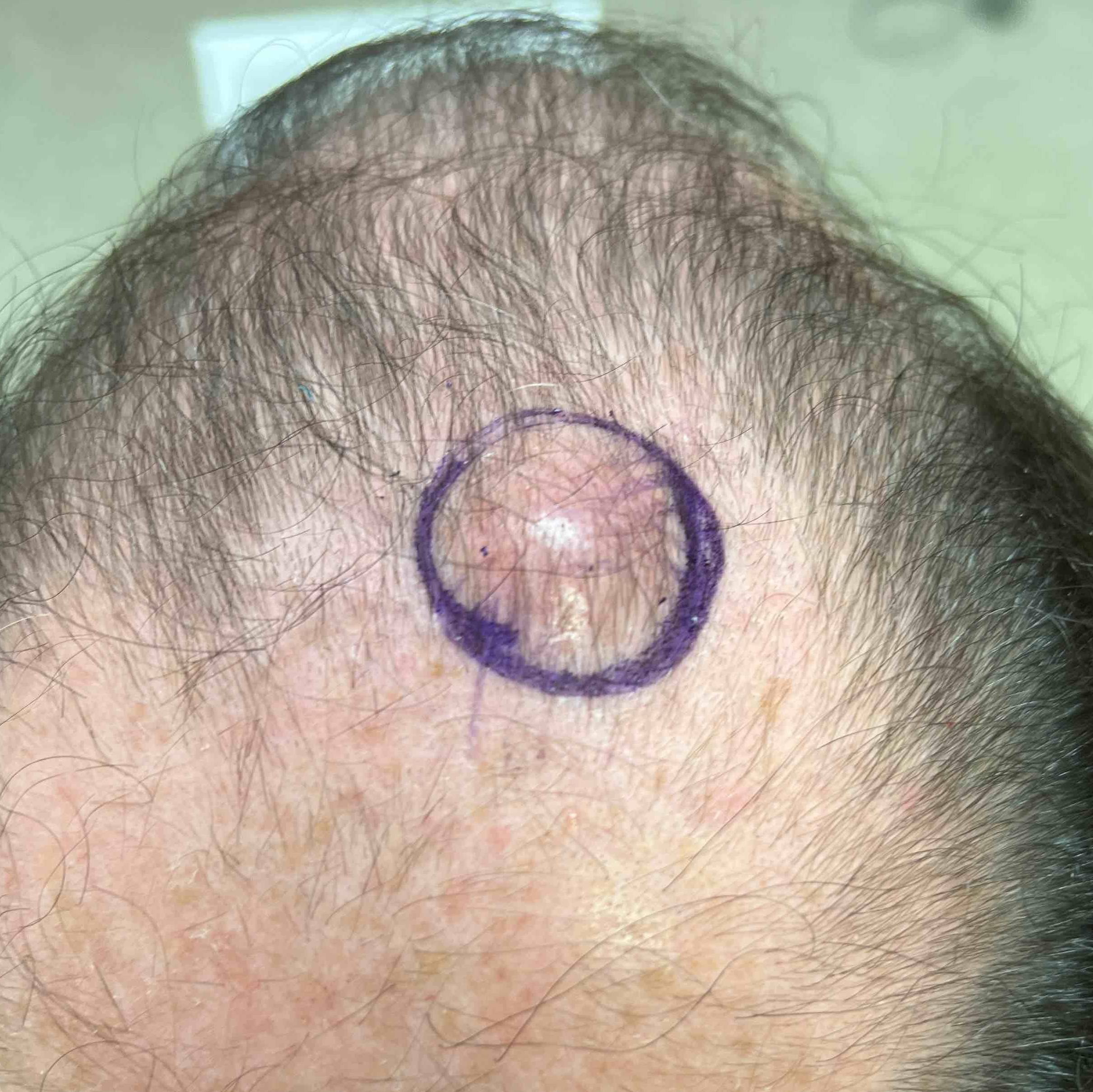 Cyst Removal Before and After Case 19 Before