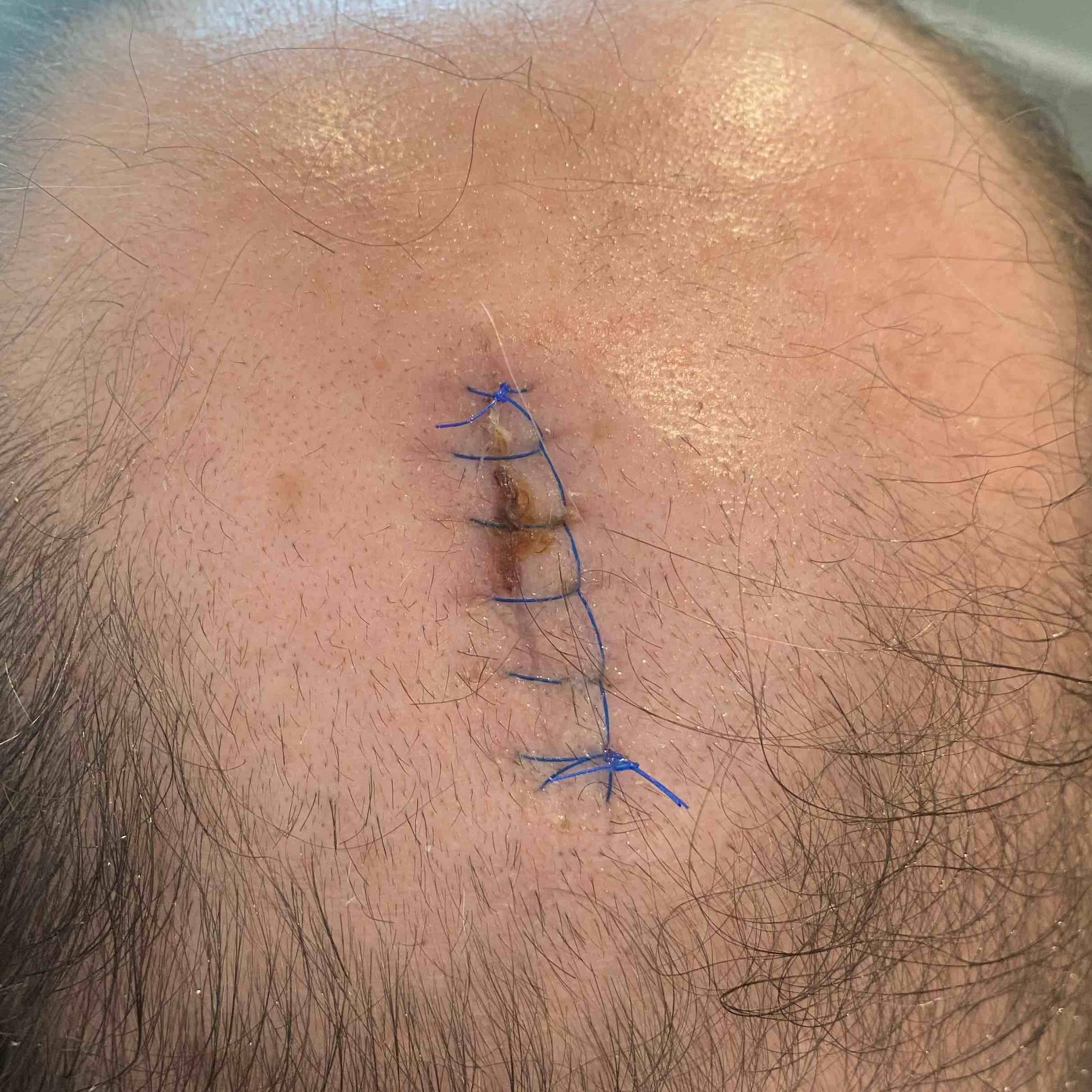 Cyst Removal Before and After Case 19 After