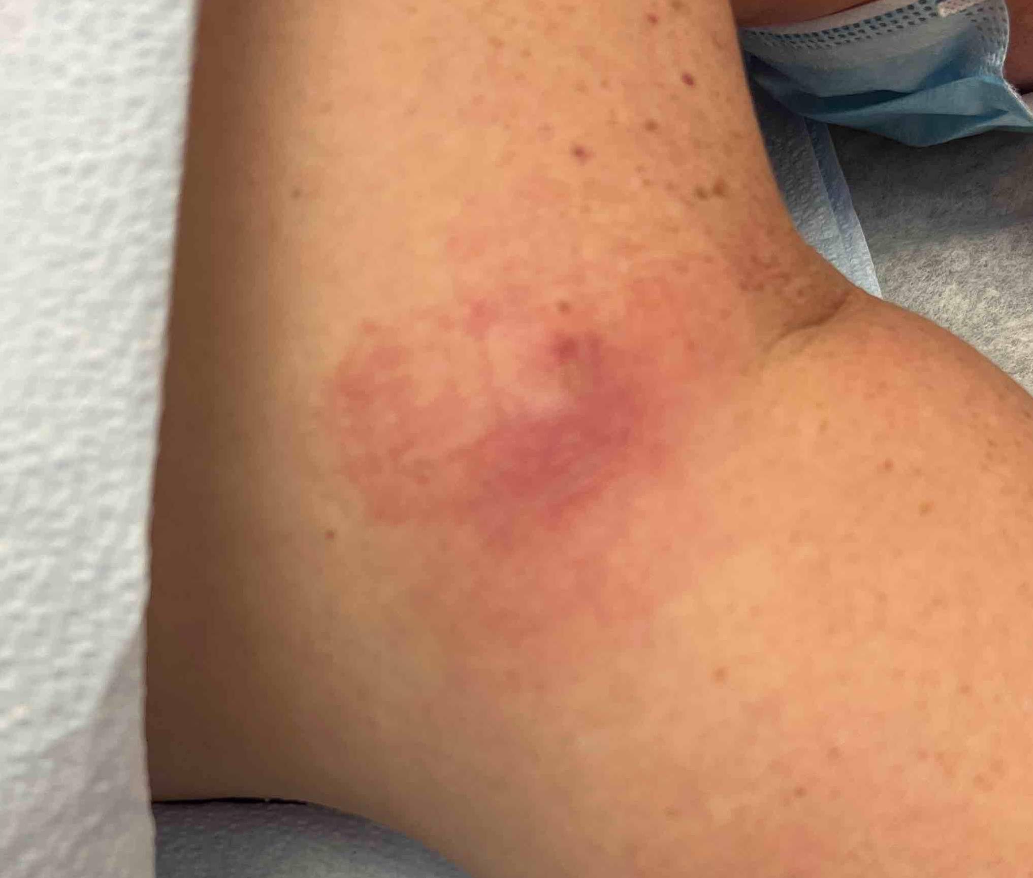 Cyst Removal Before and After Case 21 Before