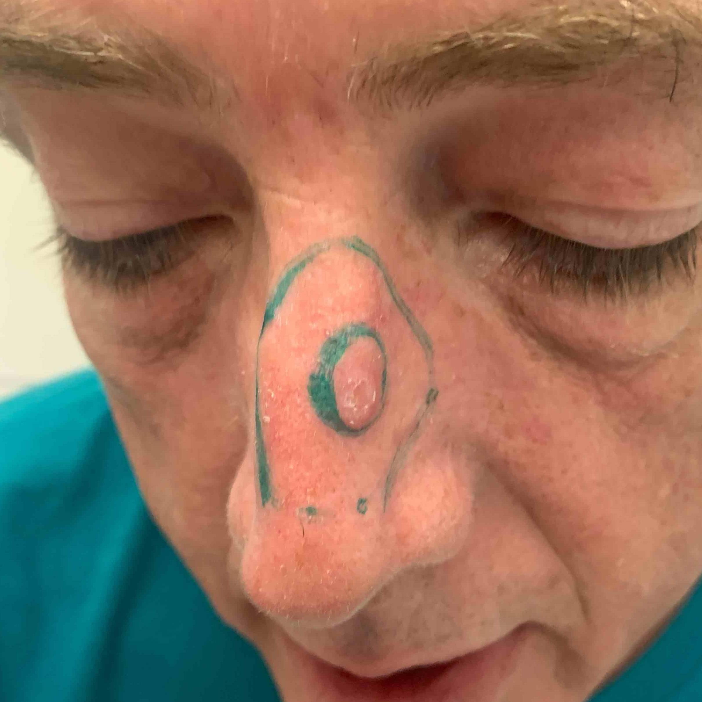 Skin Cancer Before and After Case 68 Before