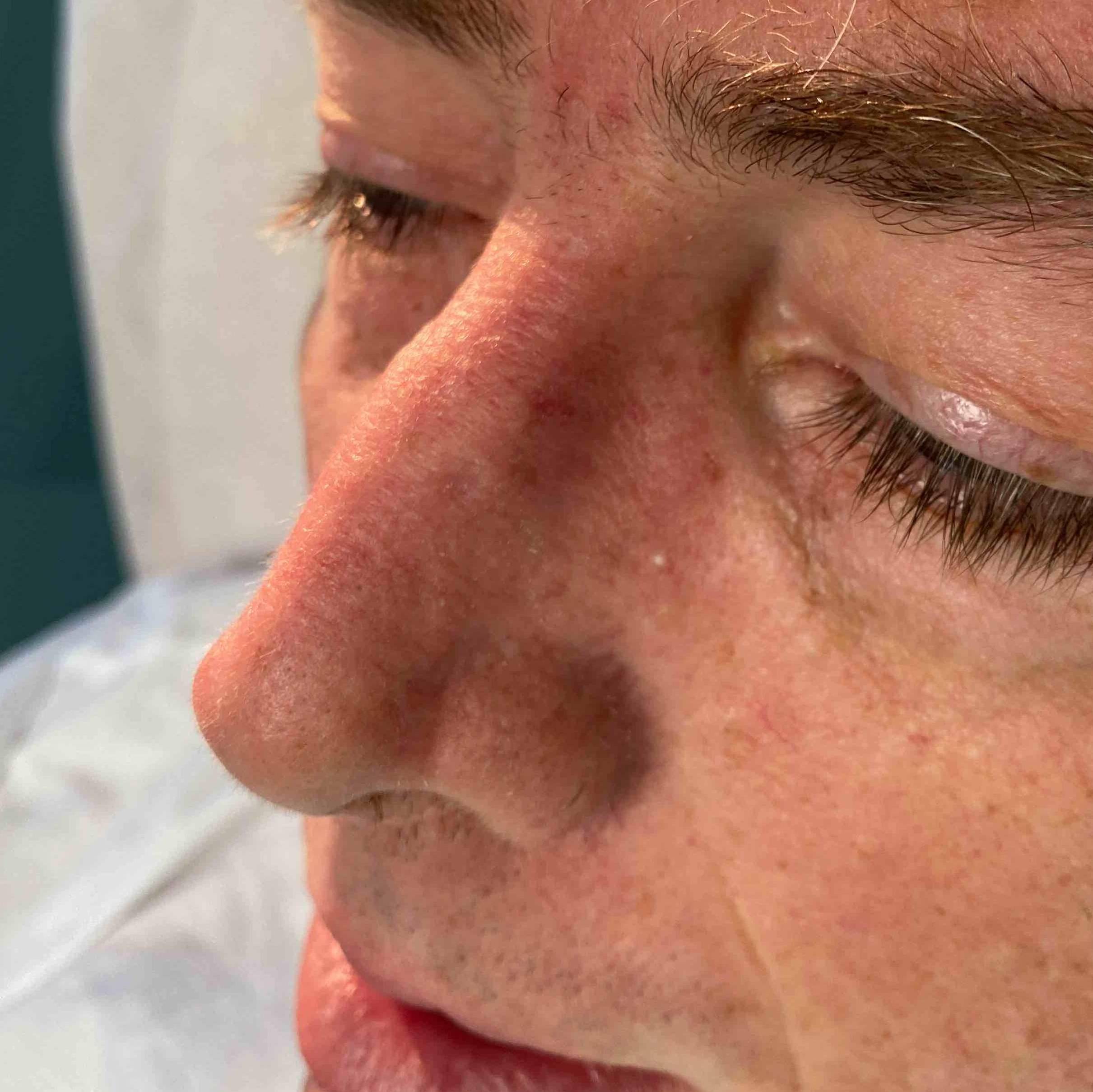 Skin Cancer Before and After Case 68 After
