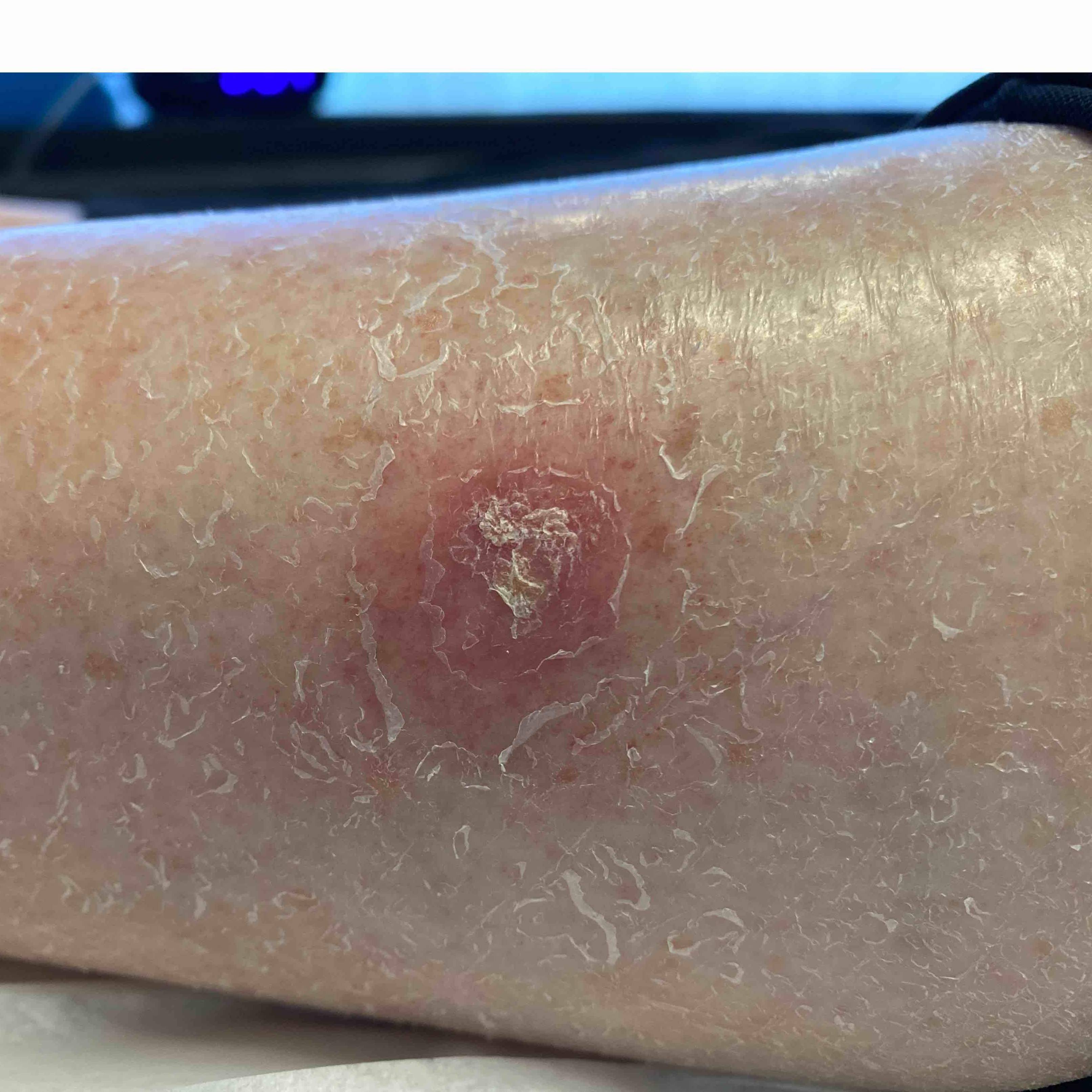 Skin Cancer Before and After Case 69 Before
