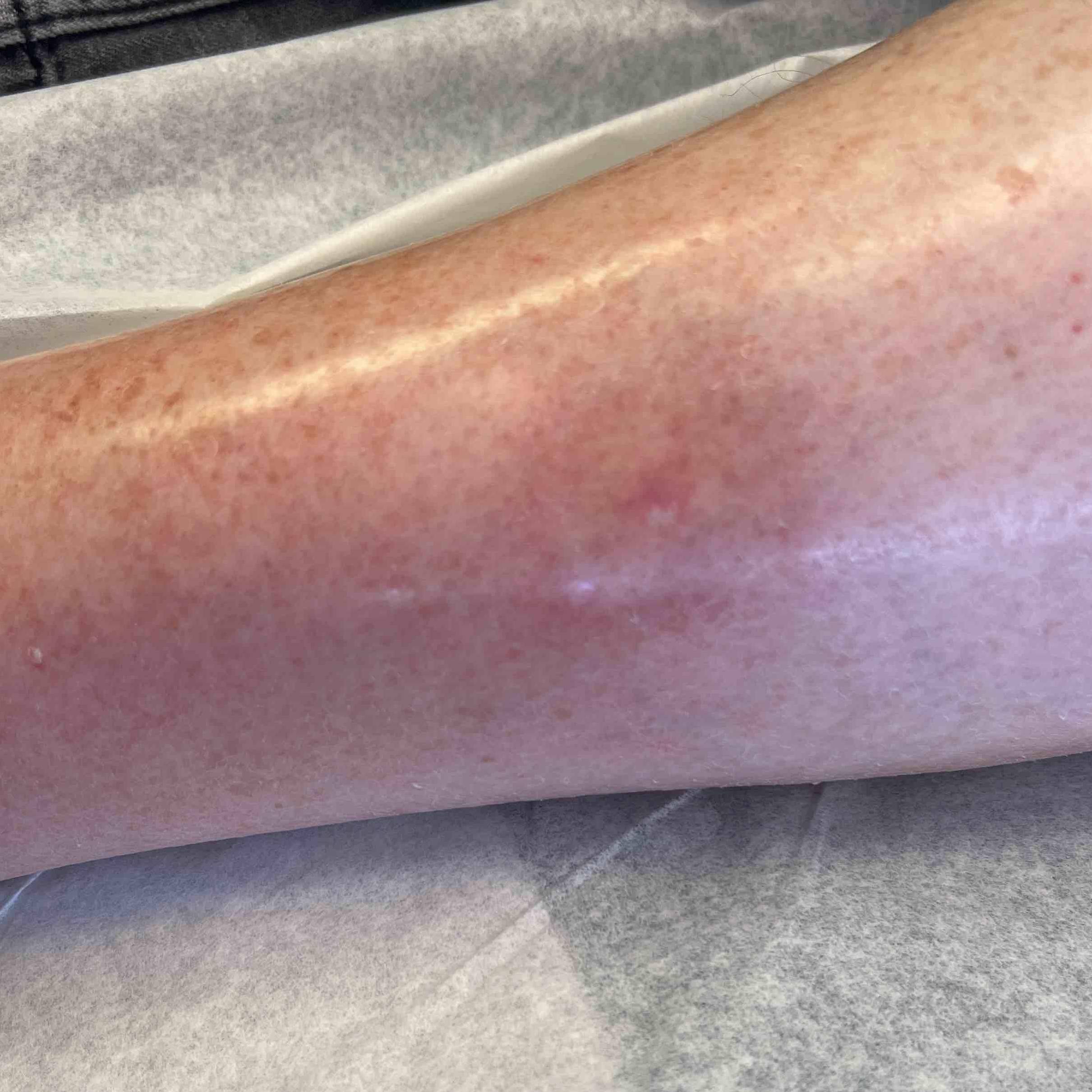 Skin Cancer Before and After Case 69 After