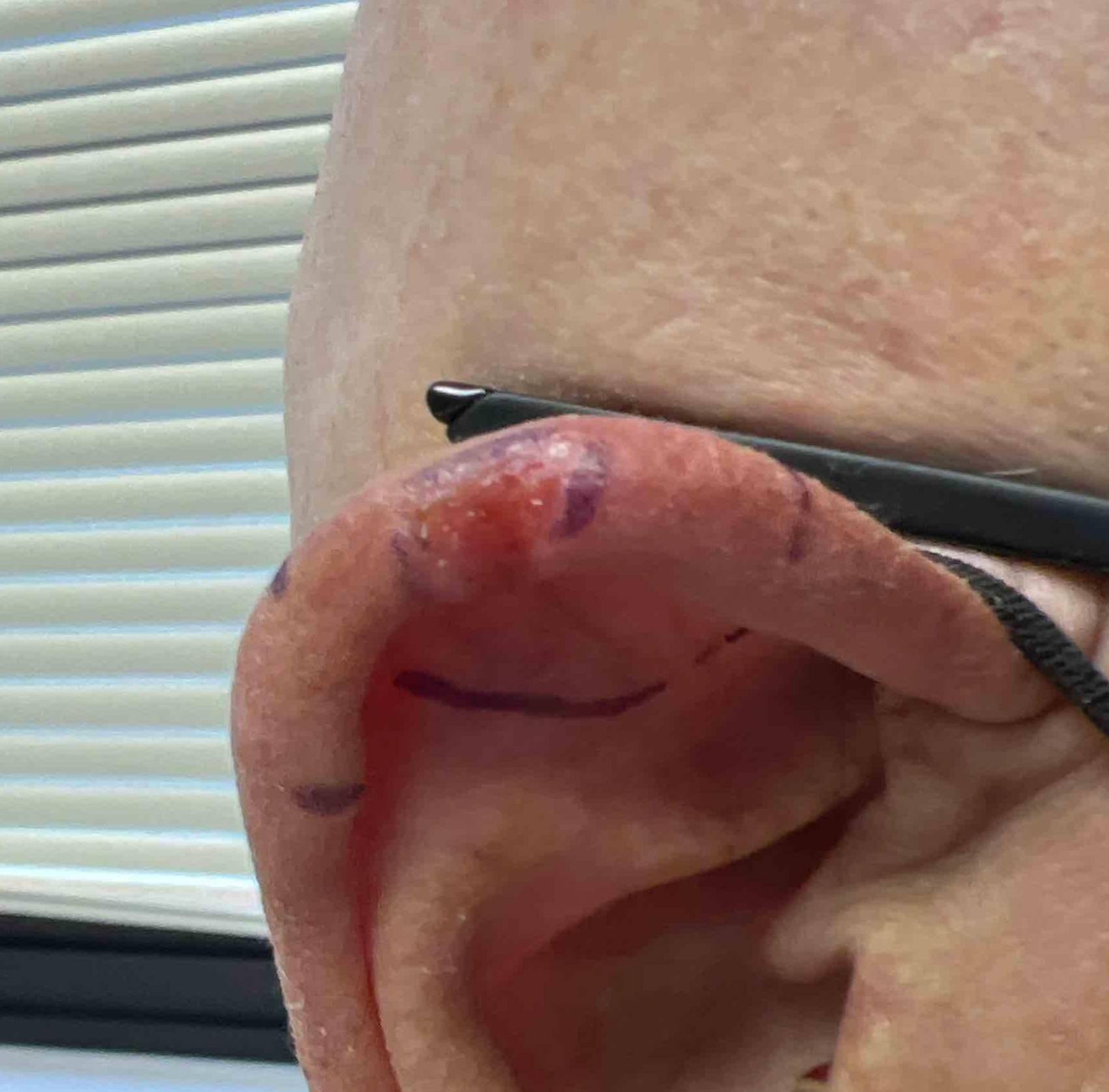 Skin Cancer Before and After Case 70 Before
