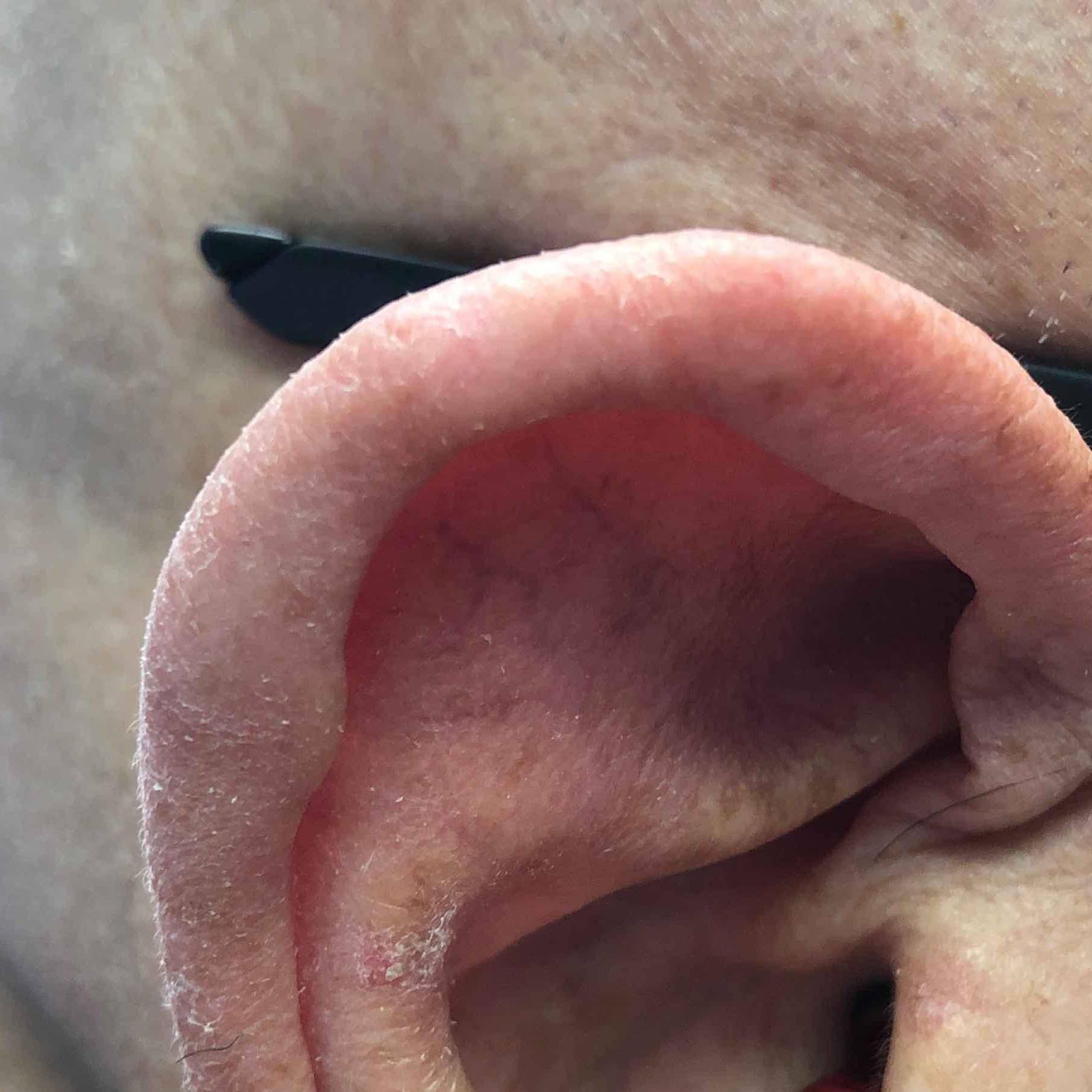 Skin Cancer Before and After Case 70 After