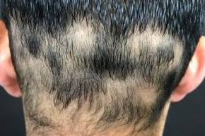 Hair Loss Before and After Case 2 Before