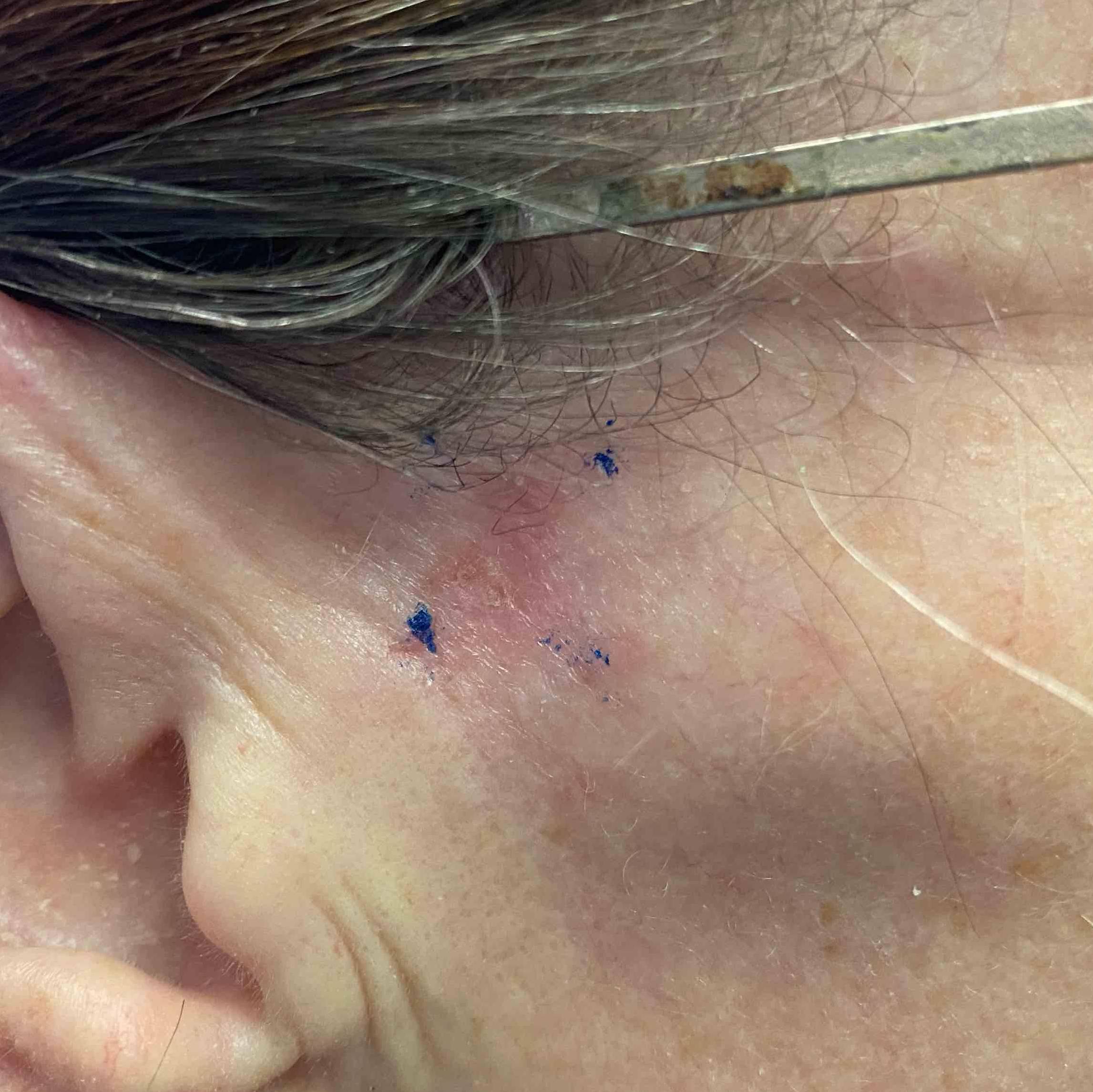 Skin Cancer  Before and After Case 71 Before