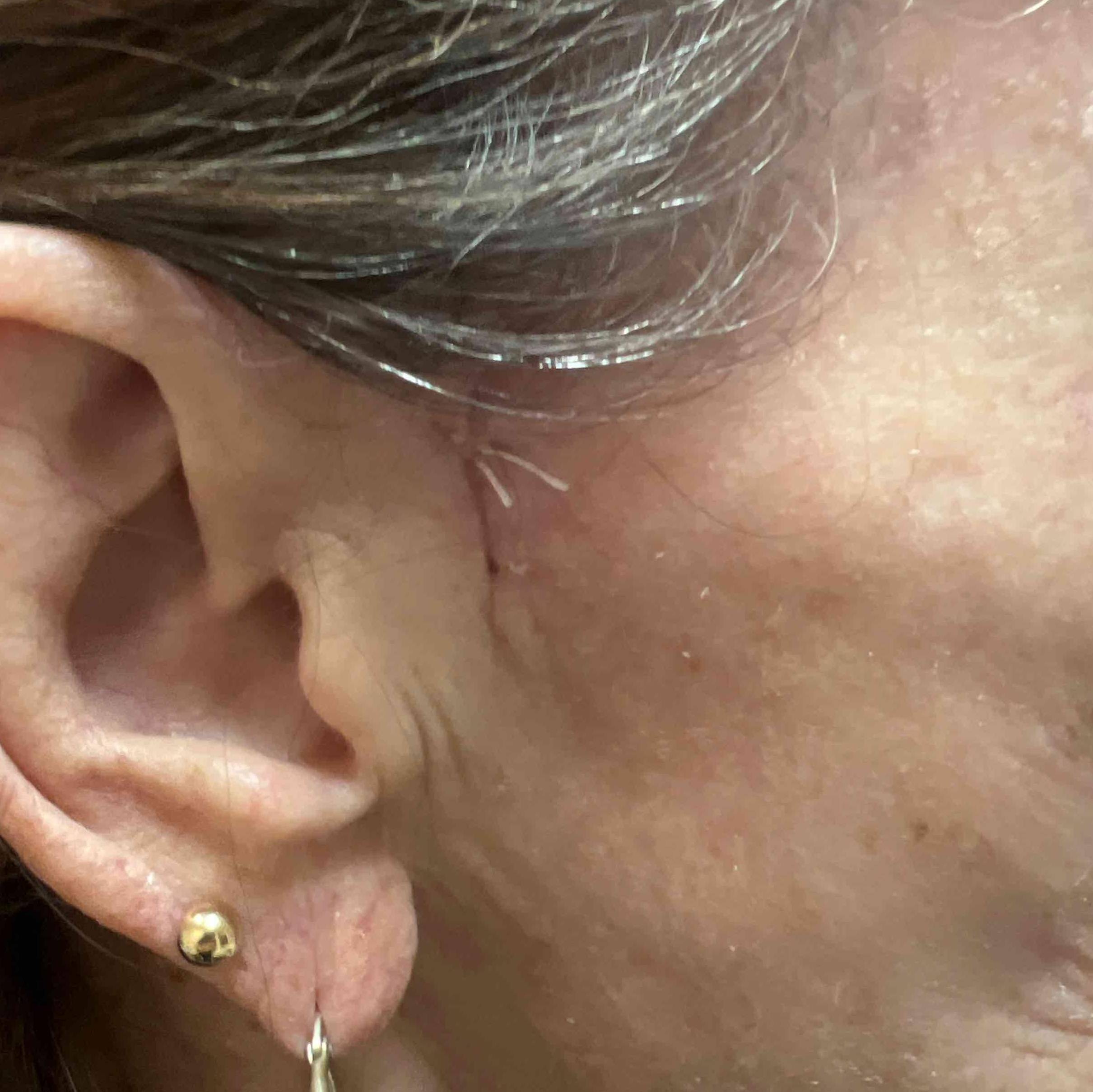 Skin Cancer  Before and After Case 71 After