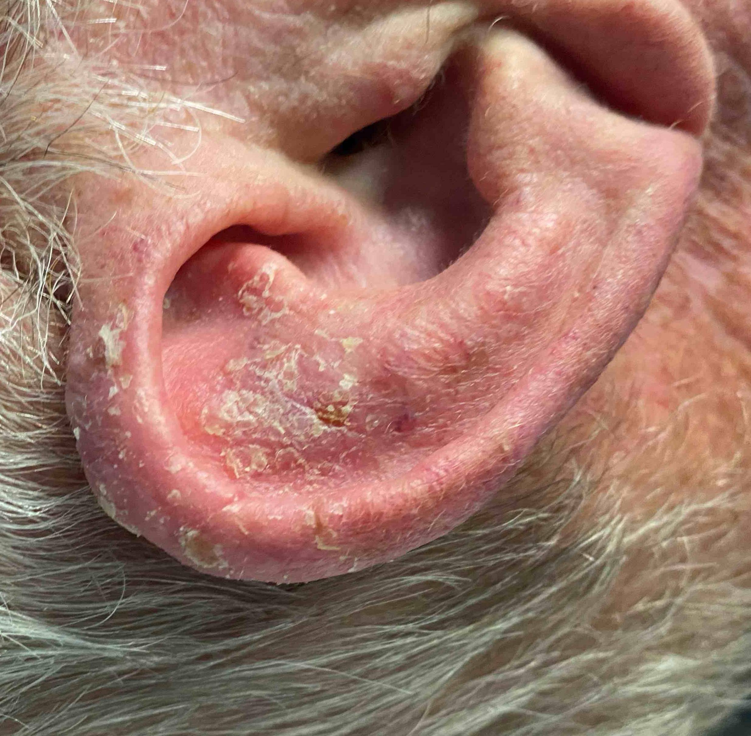 Skin Cancer Before and After Case 72 Before