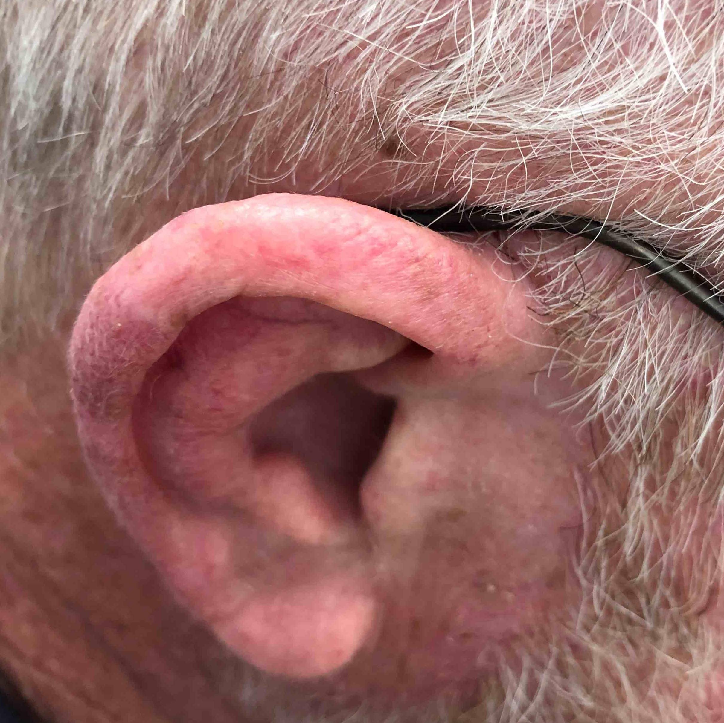 Skin Cancer Before and After Case 72 After