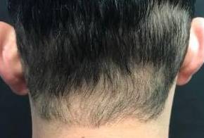 Hair Loss Before and After Case 2 After