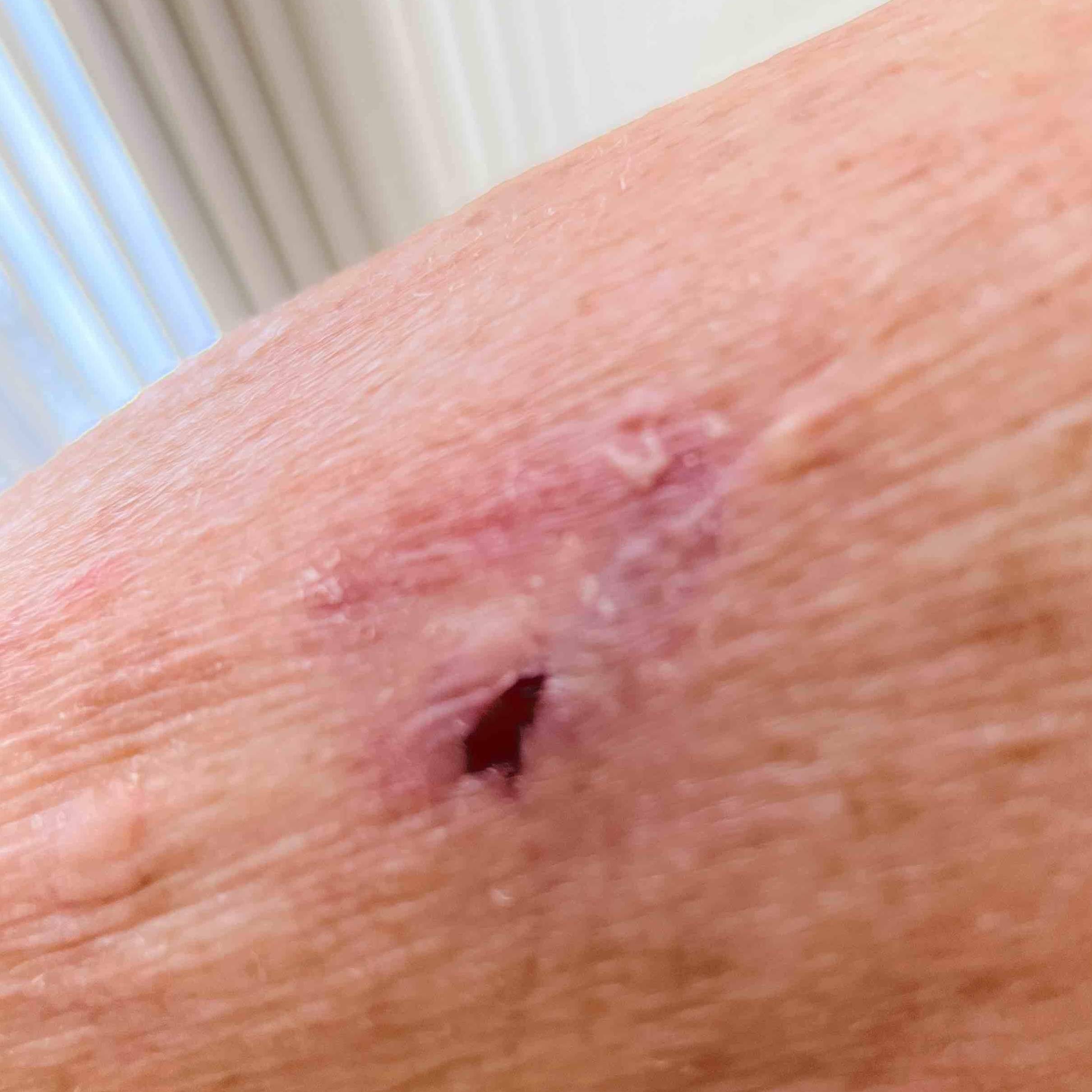 Skin Cancer Before and After Case 74 After