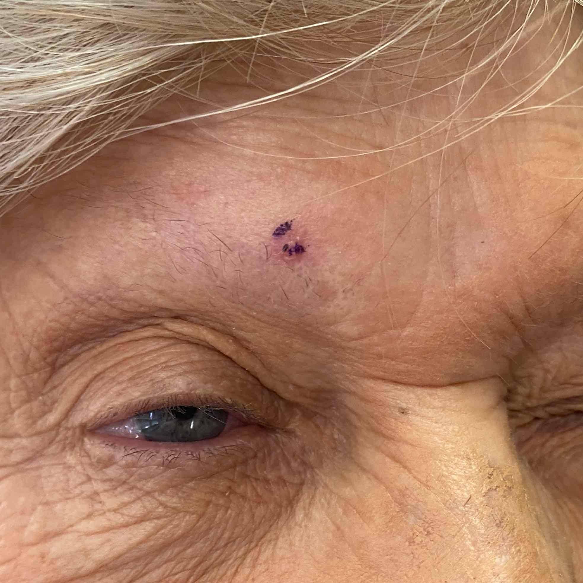 Skin Cancer Before and After Case 76 Before
