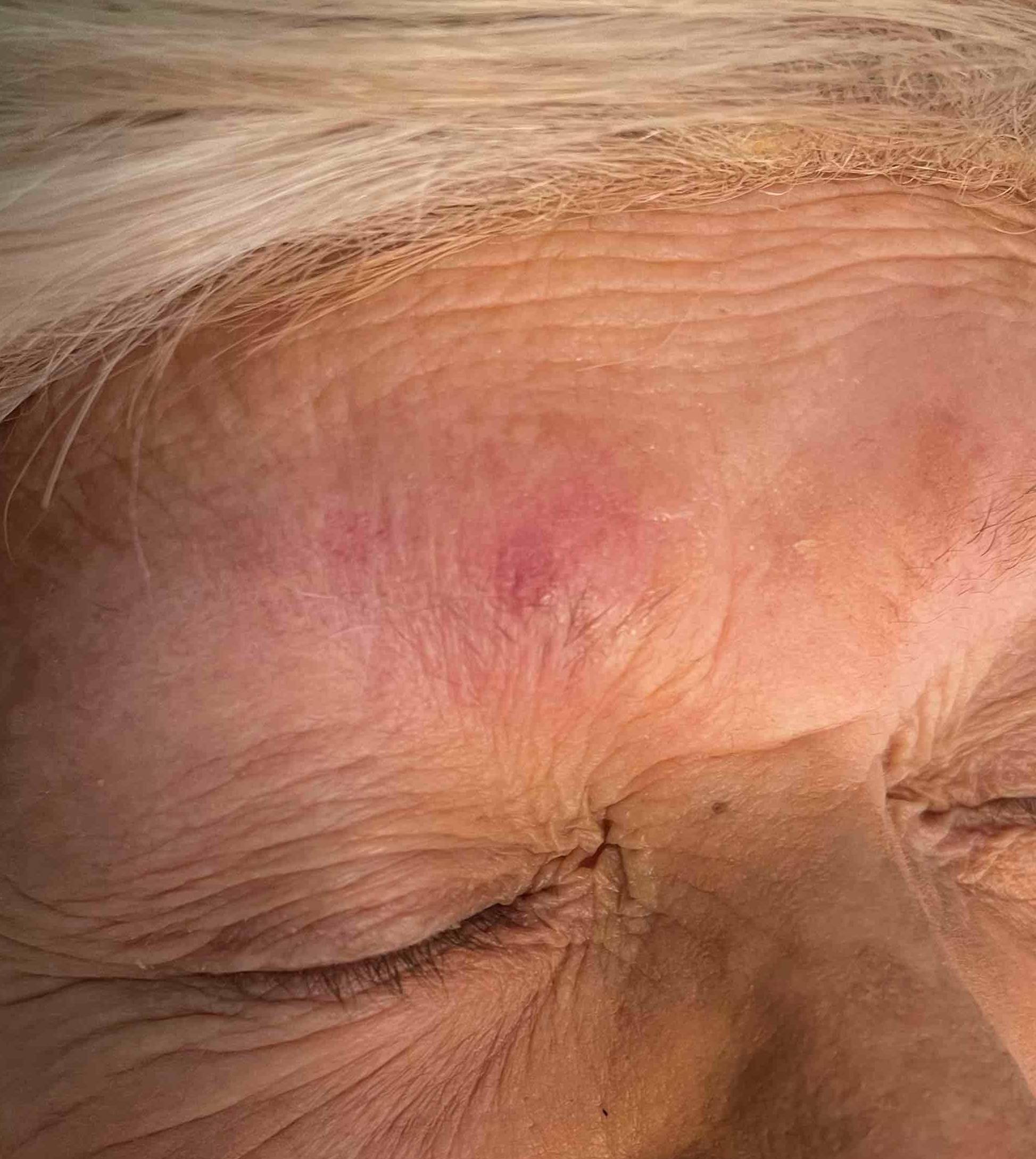 Skin Cancer Before and After Case 76 After