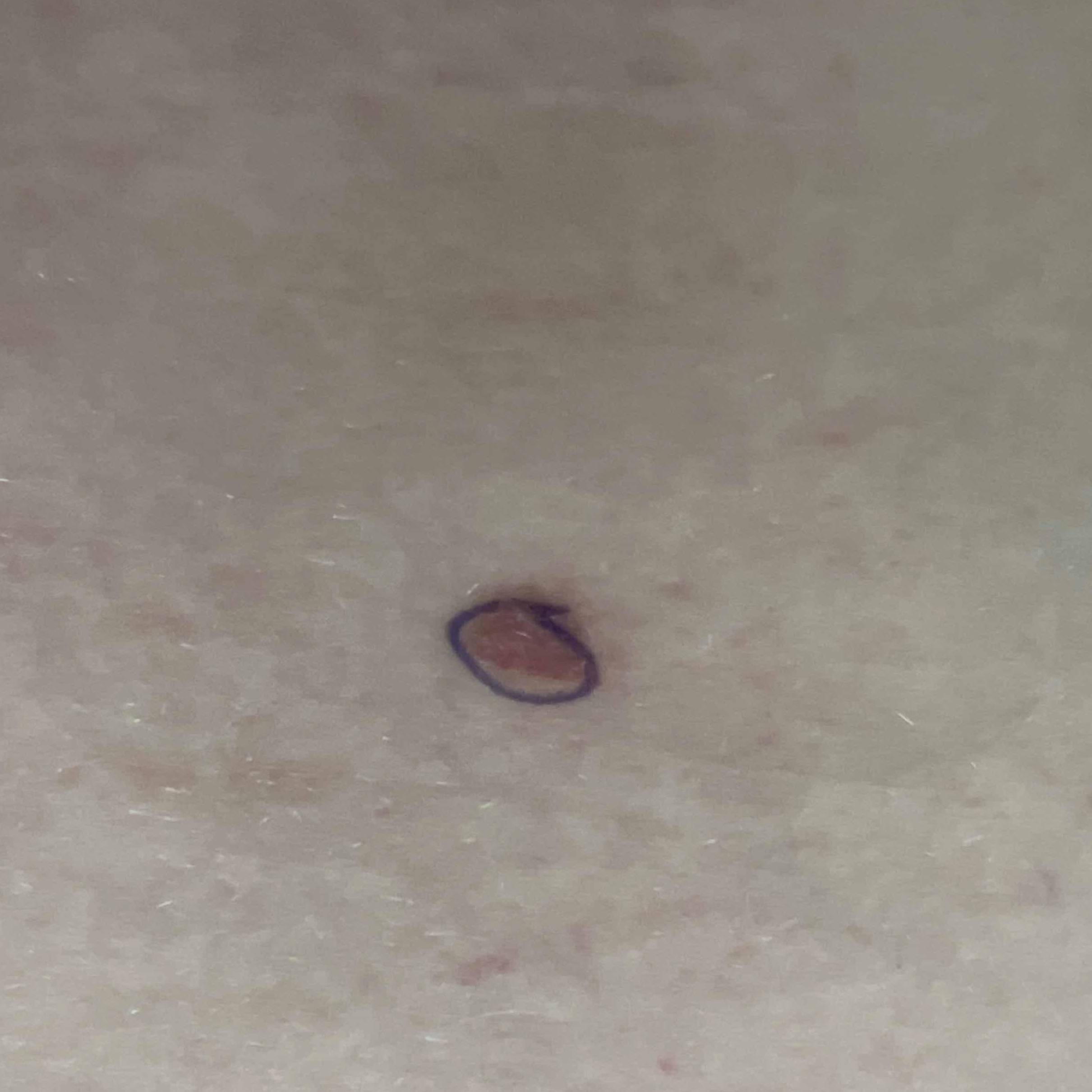 Skin Cancer Before and After Case 78 Before
