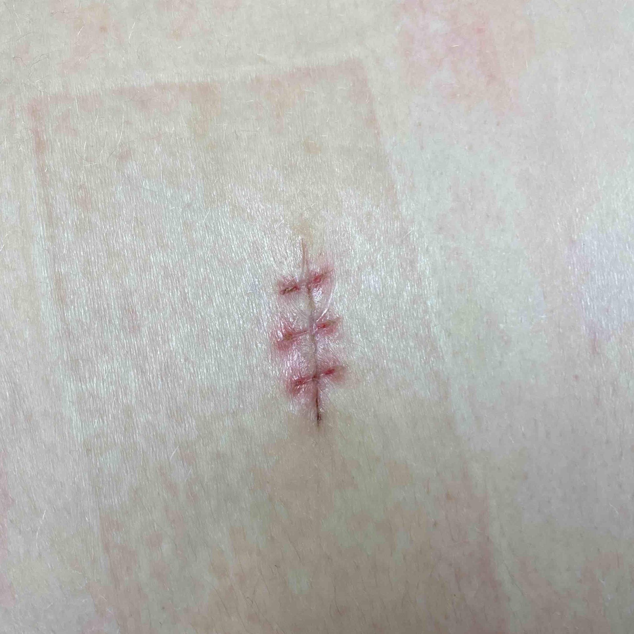 Skin Cancer Before and After Case 78 After