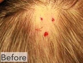 Hair Loss Before and After Case 4 Before