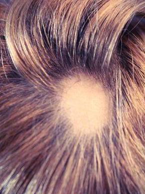 Hair Loss Before and After Case 5 Before