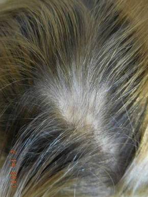 Hair Loss Before and After Case 5 After