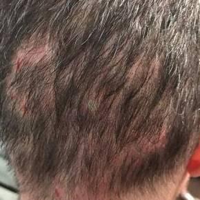 Hair Loss Before and After Case 6 Before