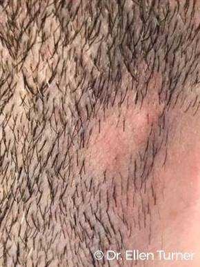 Hair Loss Before and After Case 7 Before