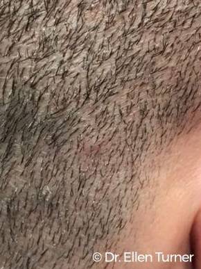 Hair Loss Before and After Case 7 After