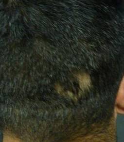 Hair Loss Before and After Case 8 Before