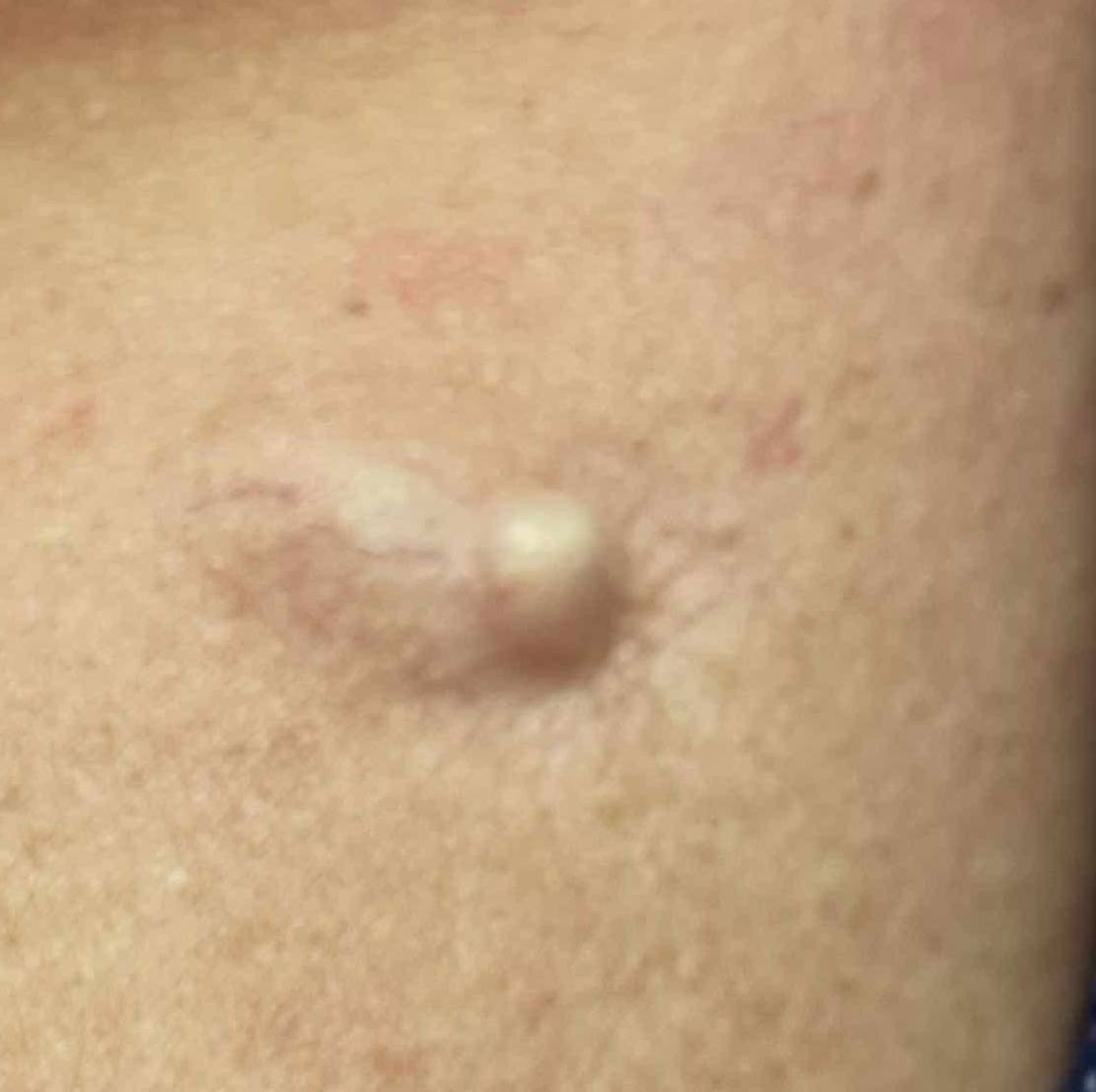 Cyst Removal Before and After Case-22 Before