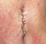 Cyst Removal Before and After Case-22 After