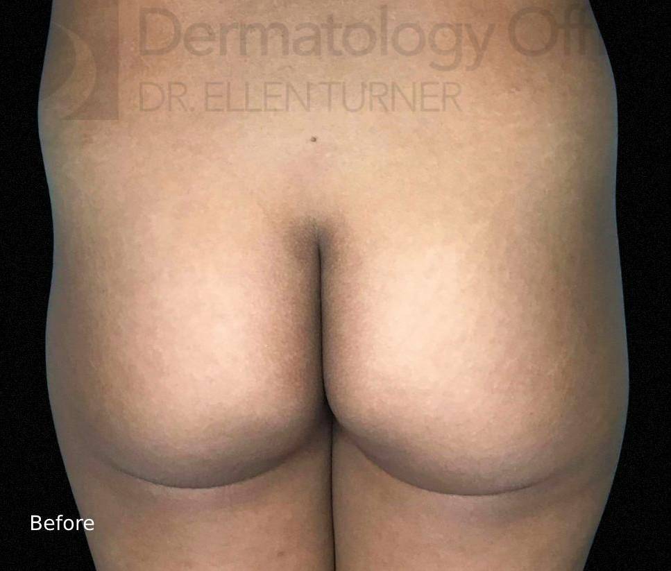 Radiesse (40+ Syringes) Before and After Case-8 Before