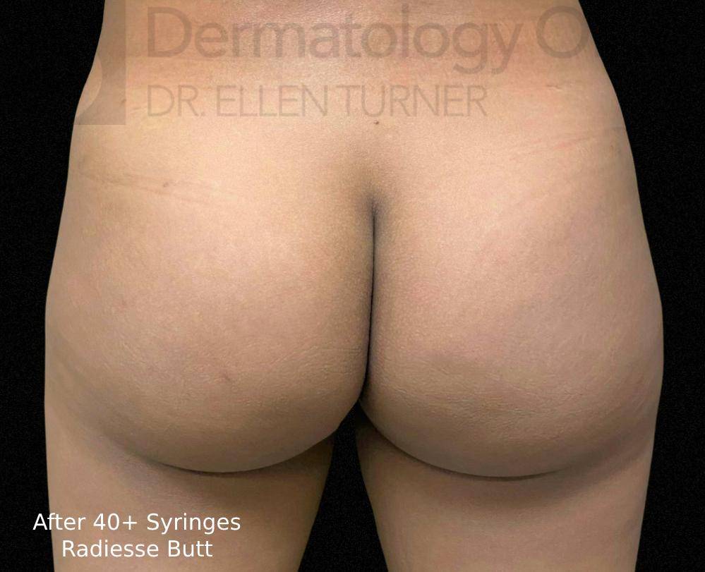 Radiesse (40+ Syringes) Before and After Case-8 After