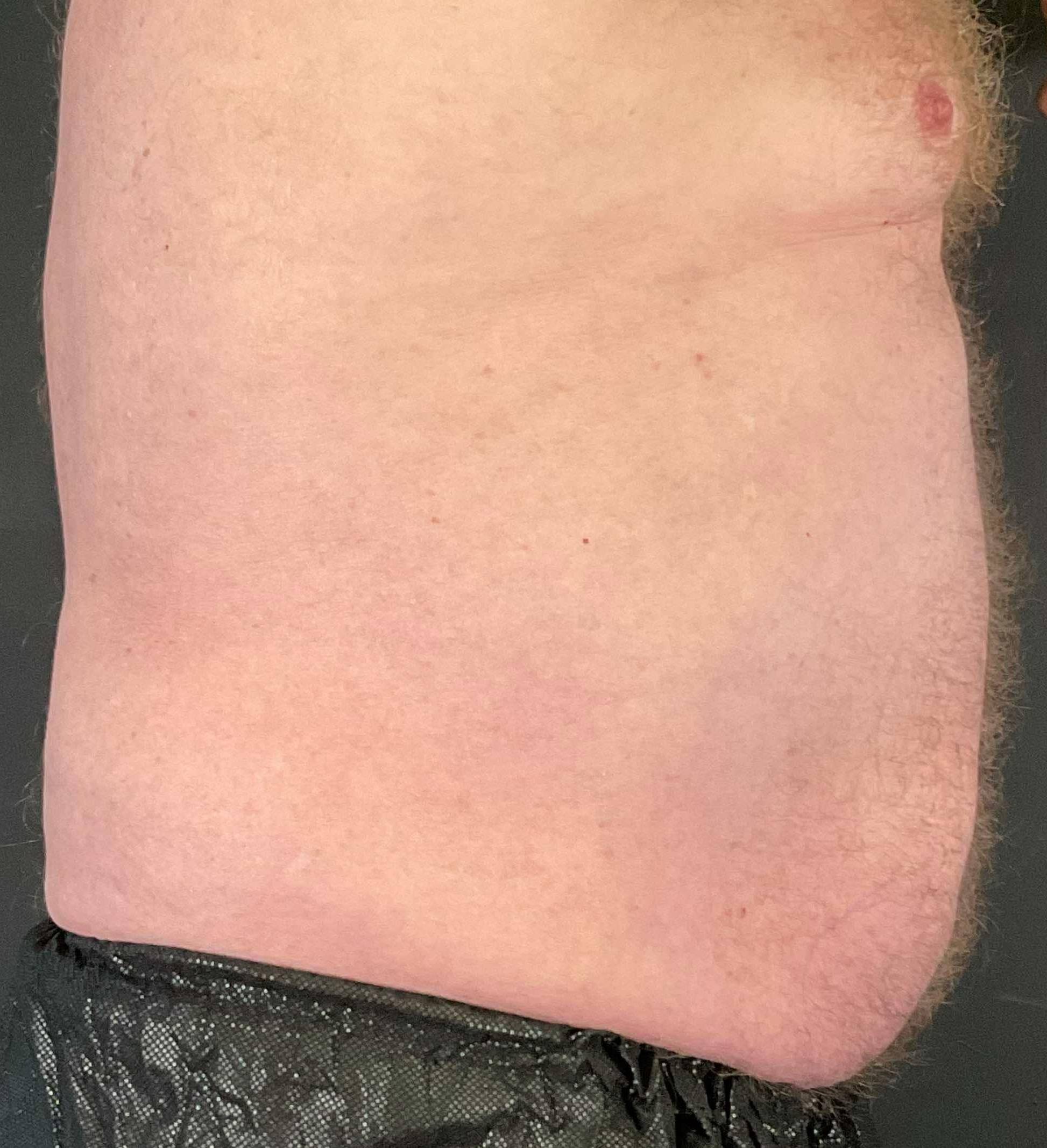EMSculpt Neo (4 Treatment) Case-3 Before