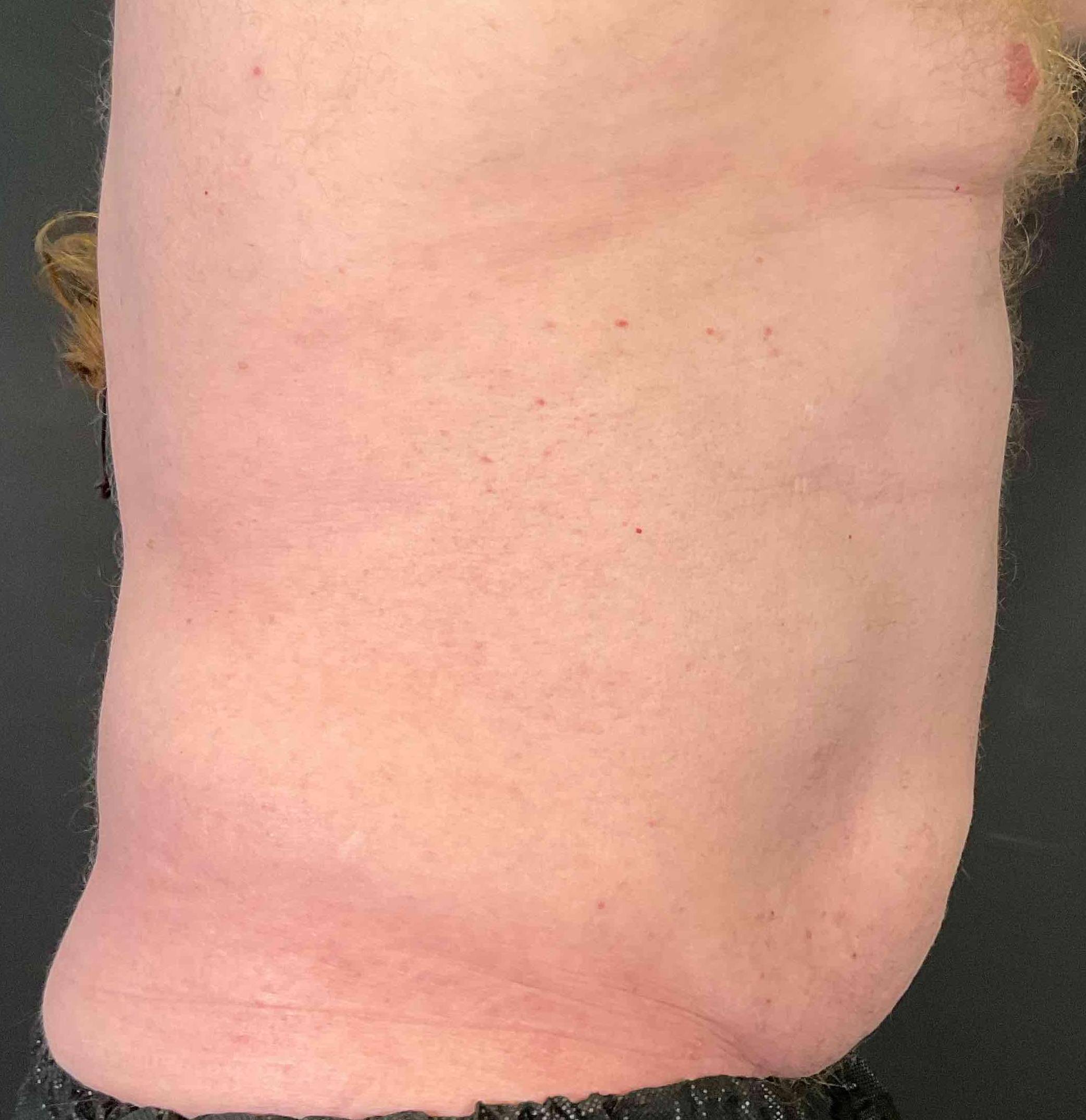 EMSculpt Neo (4 Treatment) Case-3 After