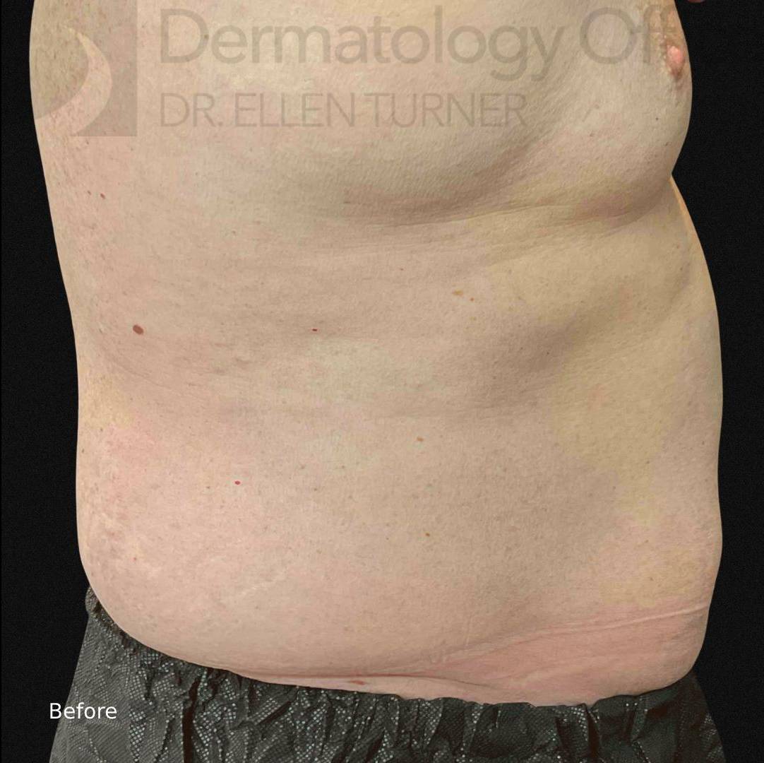 EMSculpt Neo (4 Treatment) Case-4 Before