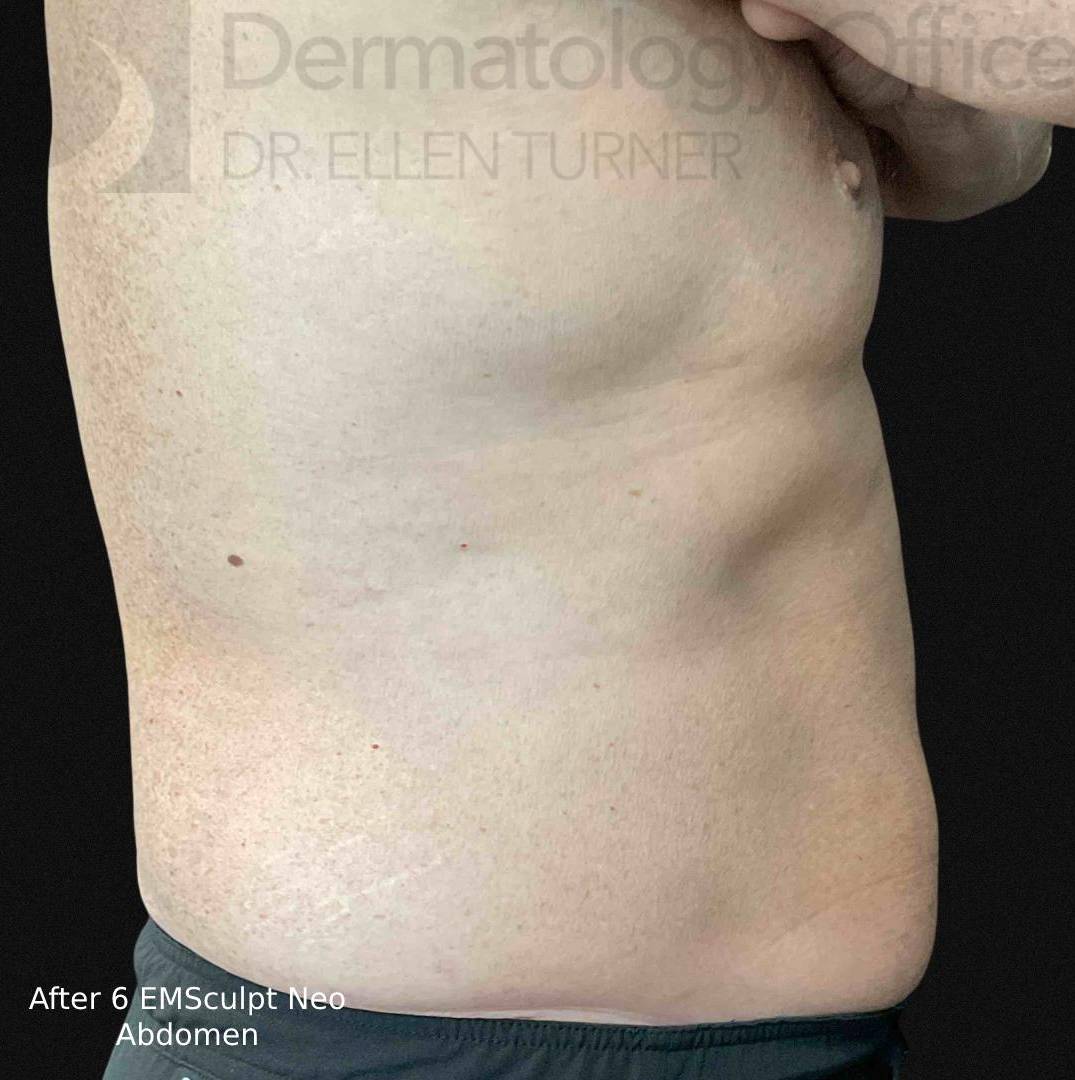 EMSculpt Neo (4 Treatment) Case-4 After