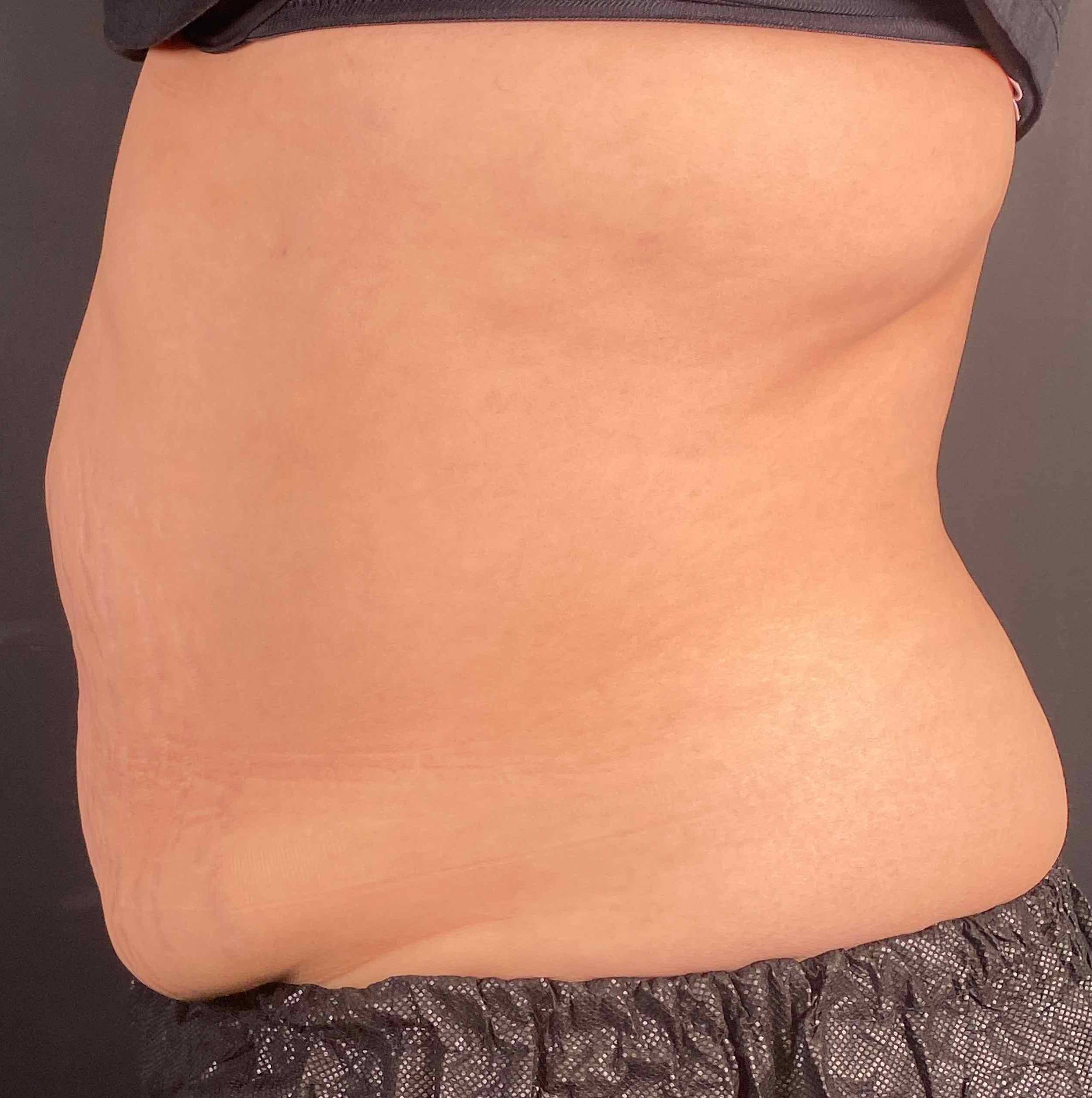 EMSculpt Neo (1 Treatments) Case-5 Before