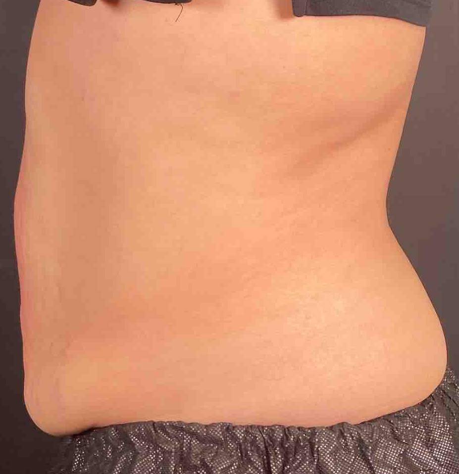 EMSculpt Neo (1 Treatments) Case-5 After