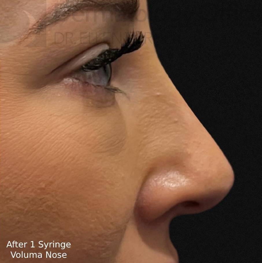 Voluma (1 Syringe) Case-22 After
