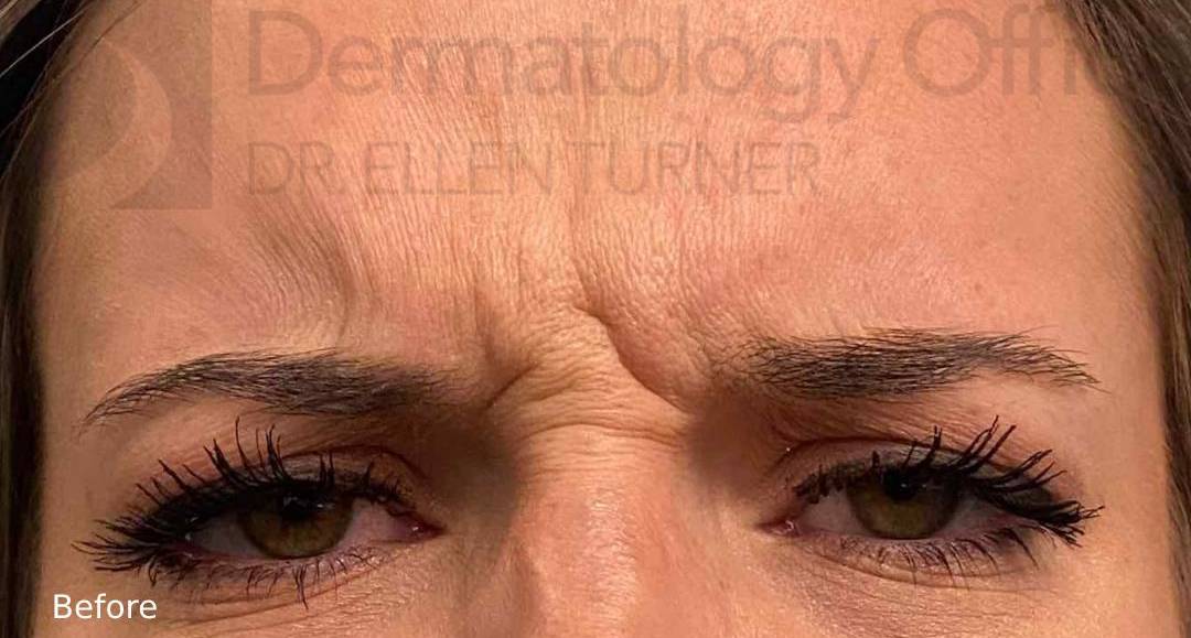 Xeomin (25 Units Glabella) Case-2 Before