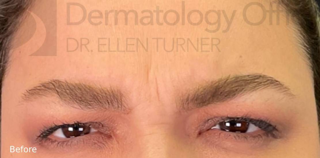 Xeomin (25 Units Glabella) Case-1 Before
