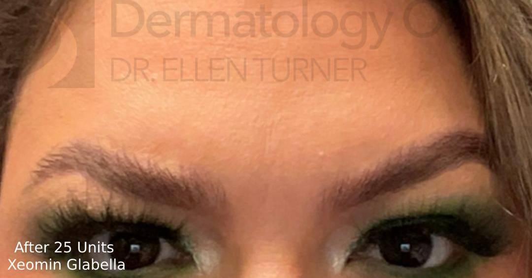Xeomin (25 Units Glabella) Case-1 After