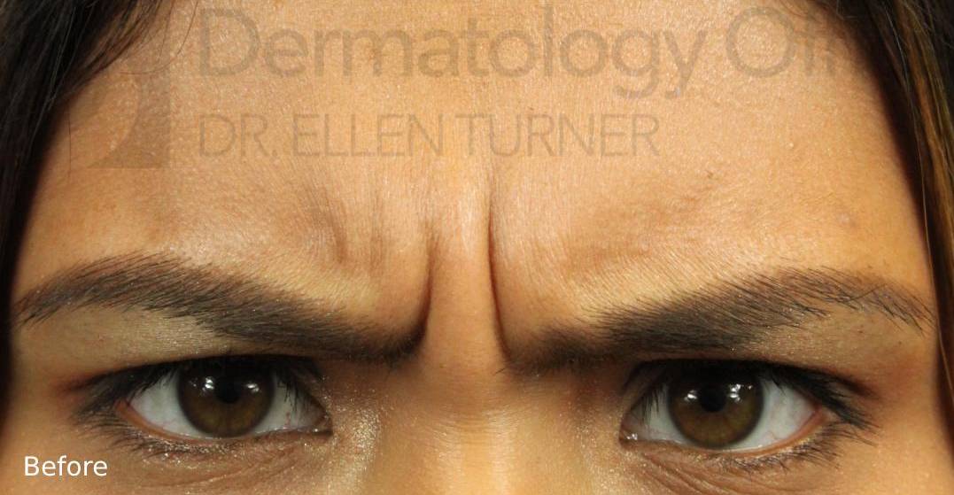 Xeomin (25 Units Glabella) Case-3 Before