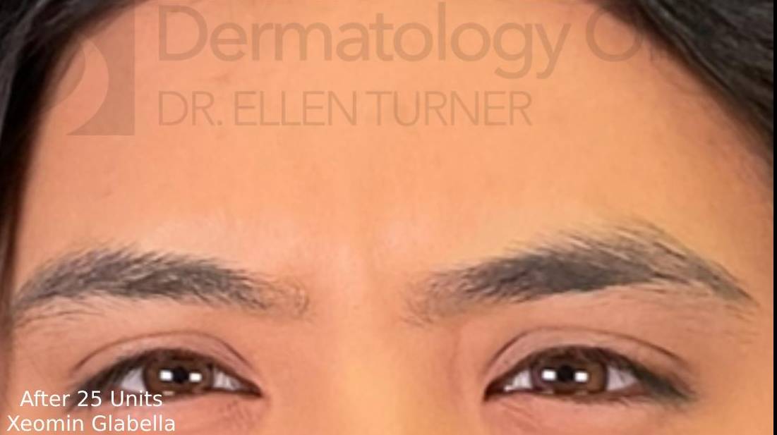 Xeomin (25 Units Glabella) Case-3 After